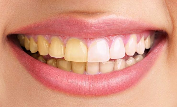 Un rimedio per i denti gialli 