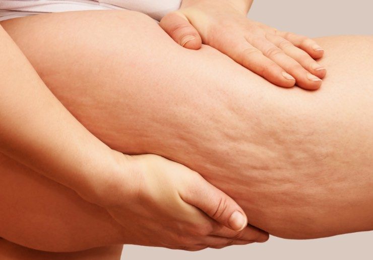 come eliminare la cellulite