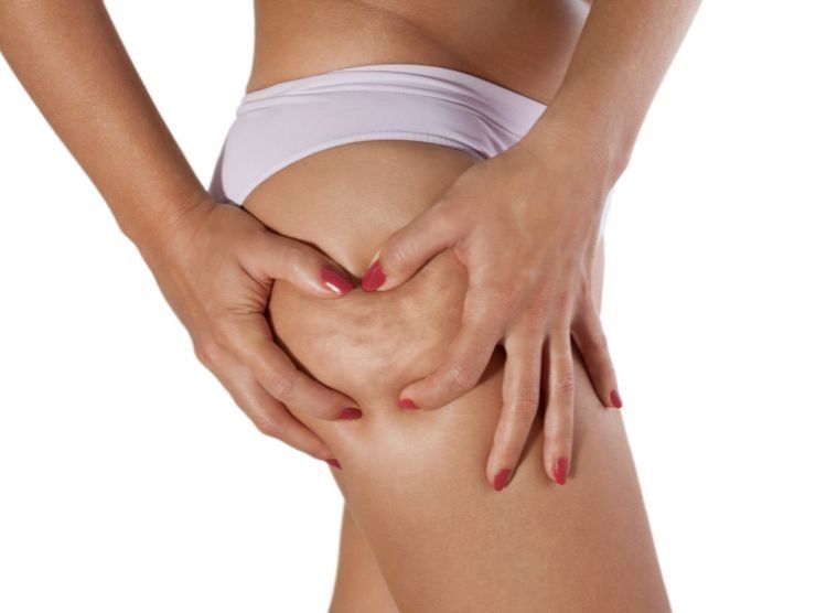 cosa sapere sulla cellulite