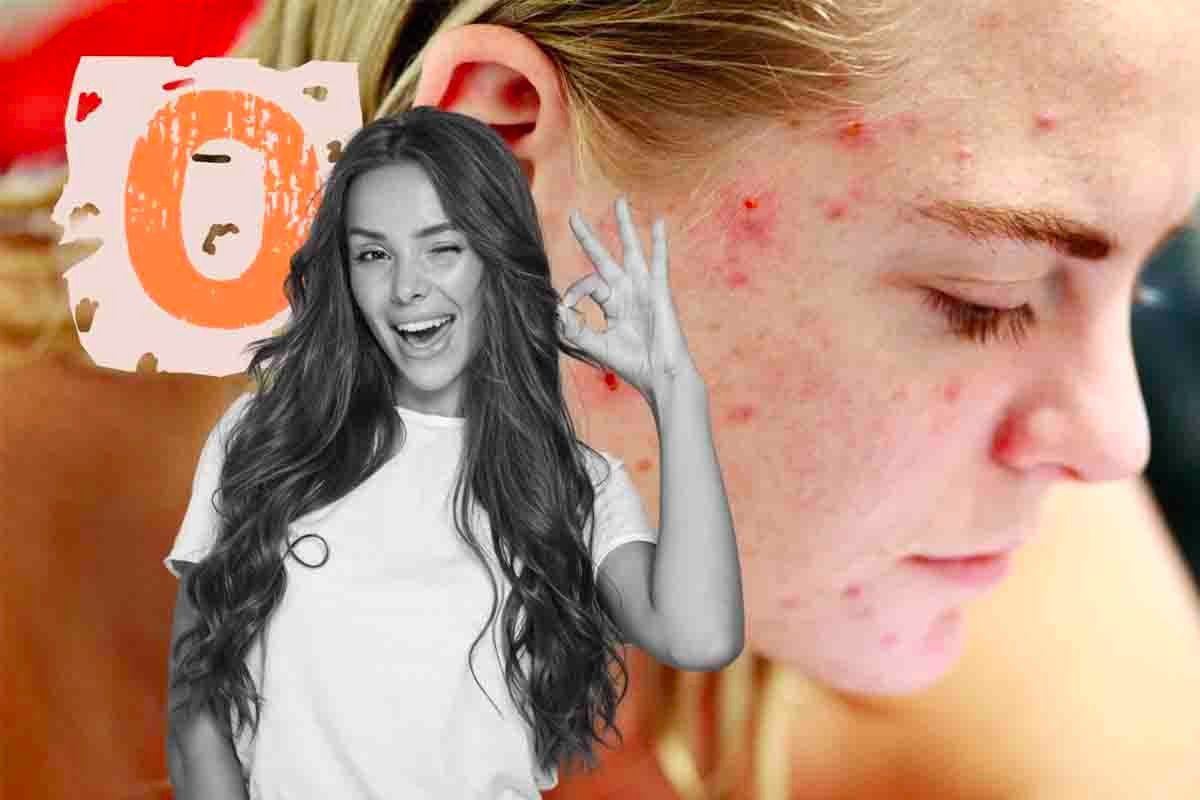 Come bloccare l'acne con prodotti specifici