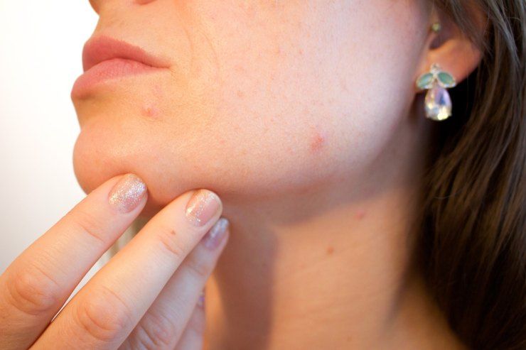 Acne: tutti i prodotti più sicuri ed efficaci